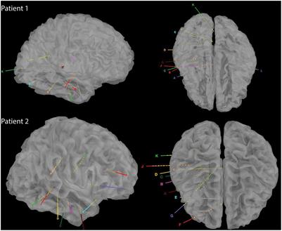 Speech decoding using cortical and subcortical electrophysiological signals